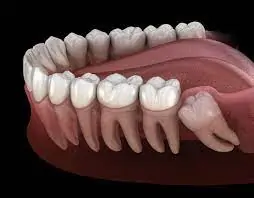 molar tooth 