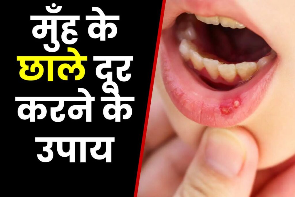 मुँह के छाले दूर करने के उपाय | Home Remedies Of Mouth Ulcers