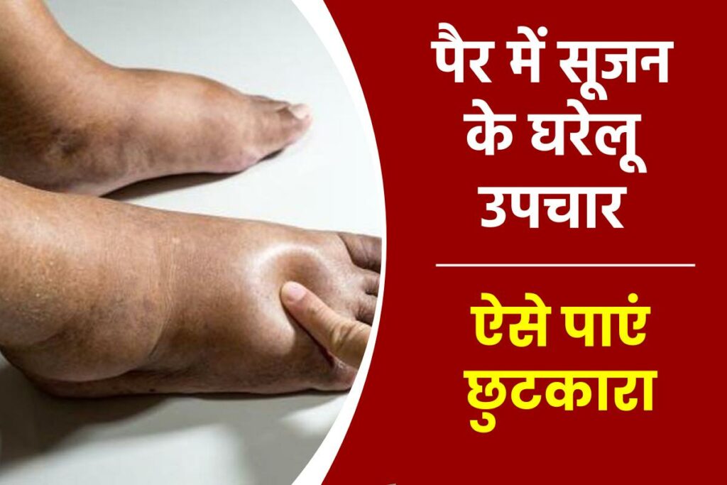 पैर में सूजन के घरेलू उपचार : Pair Mein Sujan Ke Gharelu Upchar