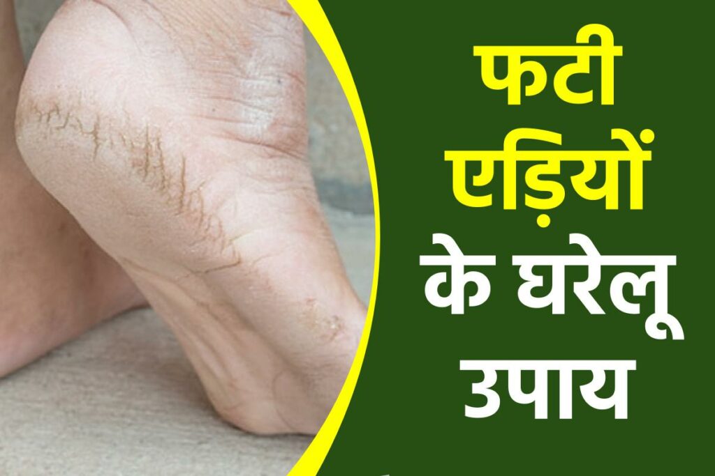 फटी एड़ियों के घरेलू उपाय | Home Remedies for Cracked Heels in Hindi